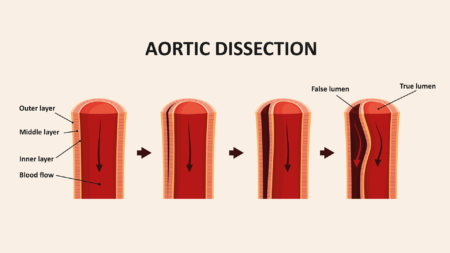 Endovasküler Aortic dissection TR 1