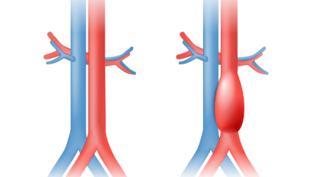 Endovasküler Endovastec3 TR 1
