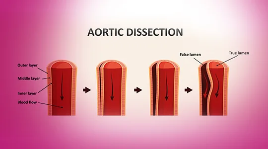 Aortic Aneurism Patients Abnominal aortic Aneurysm4 1