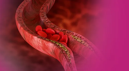 Arteriosclerosis Patients Arteriosclerosis1 1