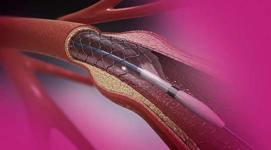 Arteriosclerosis Patients Arteriosclerosis3 1