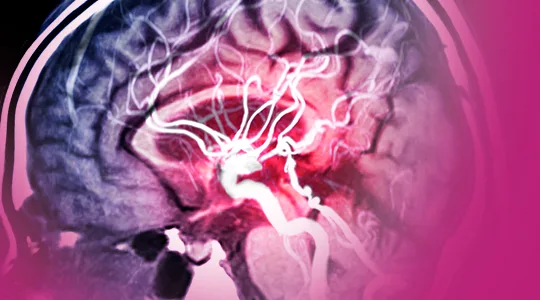 Stroke Patients stroke5 1